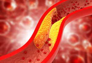 Read more about the article 10 shocking Home Remedies Of Atherosclerosis