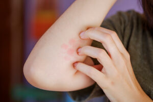 Read more about the article 7 Home Remedies Of Ringworm